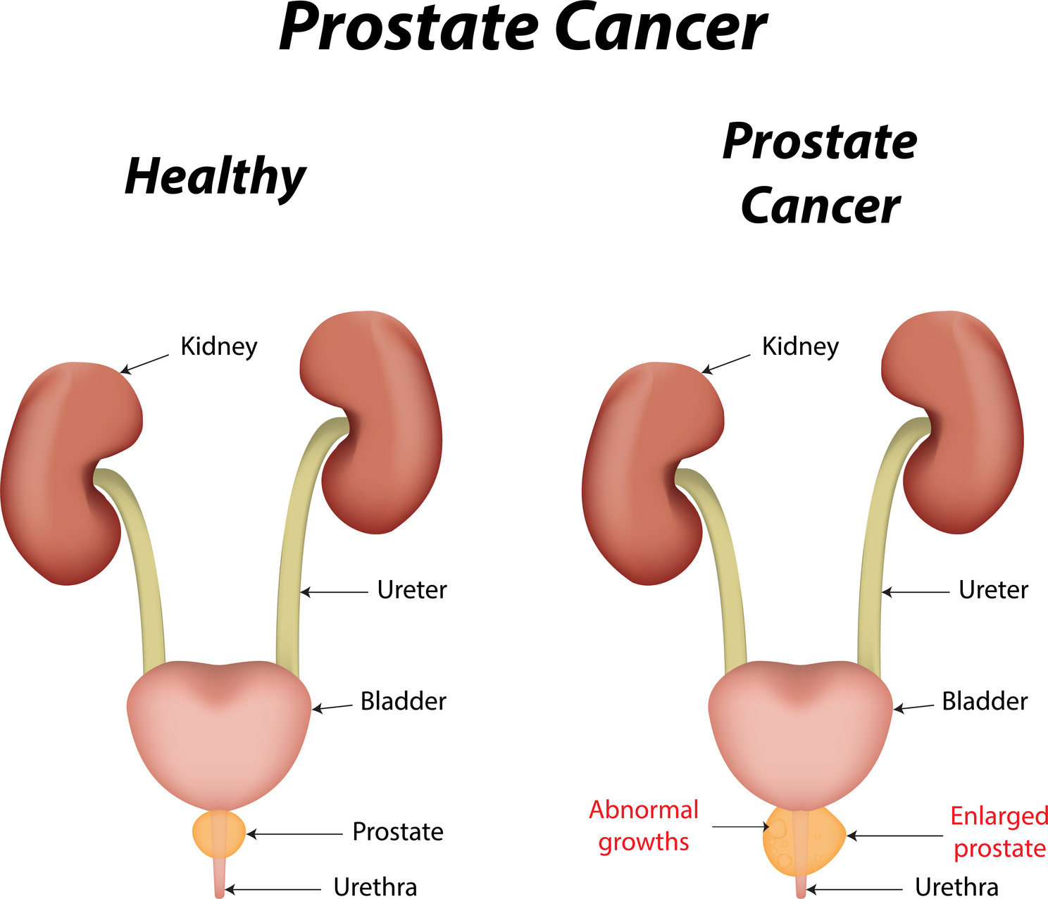 All you need to know about prostate cancer