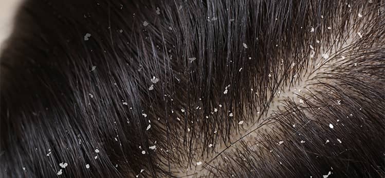 Does dandruff cause hair fall? - letsdiskuss