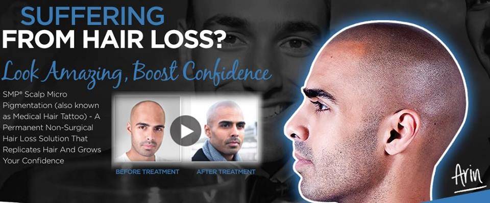 Reasons to opt for scalp micropigmentation Glasgow for excessive hair loss