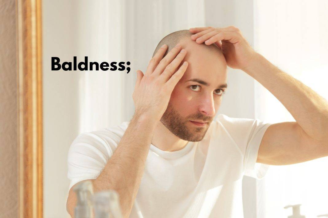 How to Cure Baldness with the Help of Natural Remedies