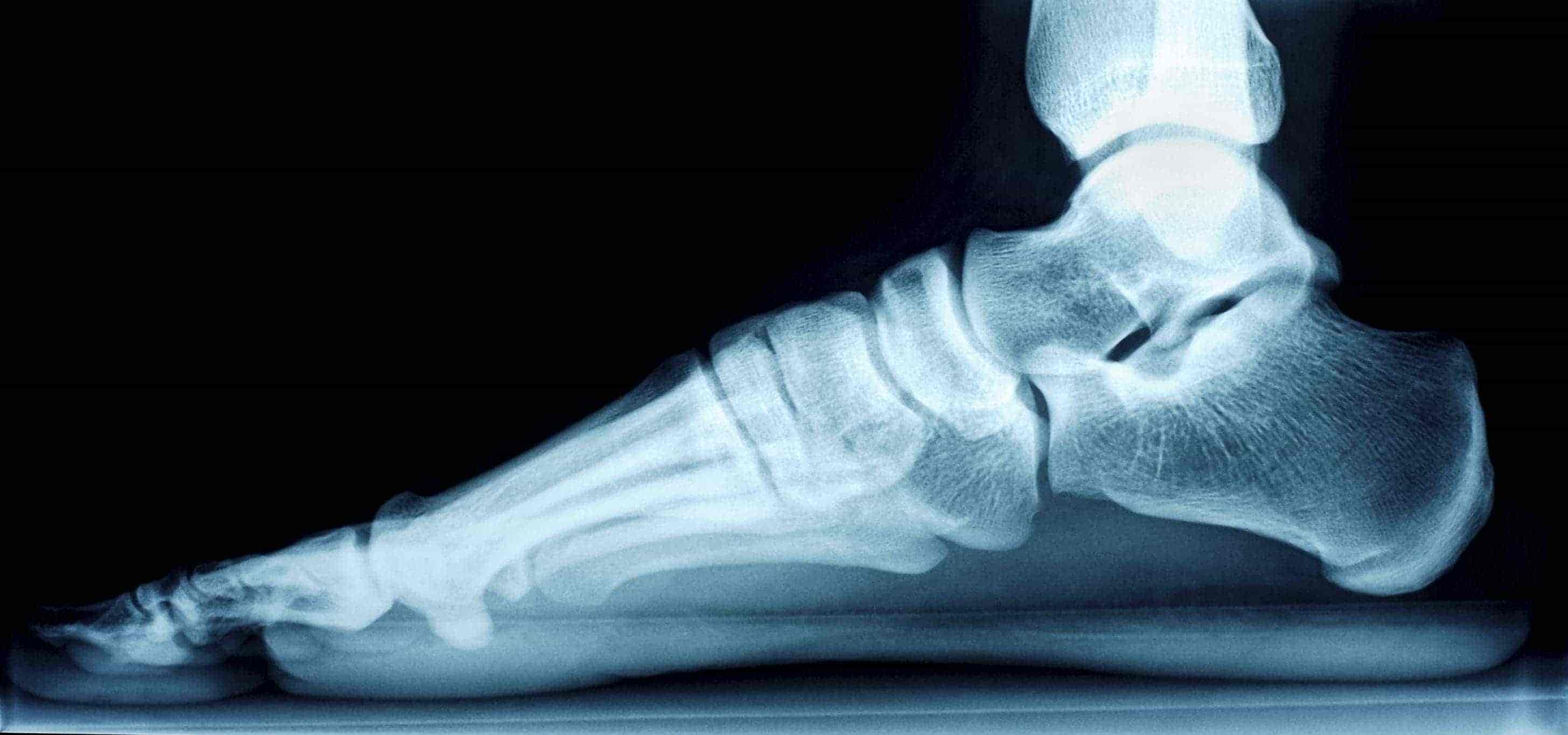 Flat Feet Symptoms Causes And Treatments