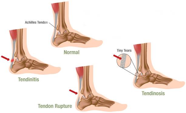 What Causes Flat Feet